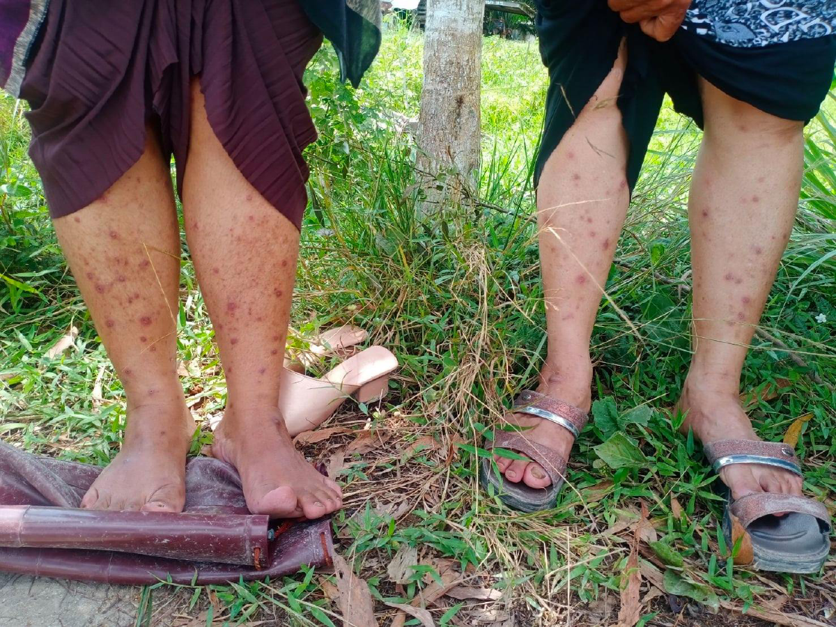 \"หมอสุภัทร\" ยกเคส \"โรคหอยคัน\" ผื่นขึ้นแขนขา กระจาย 7 ตำบลในจะนะ