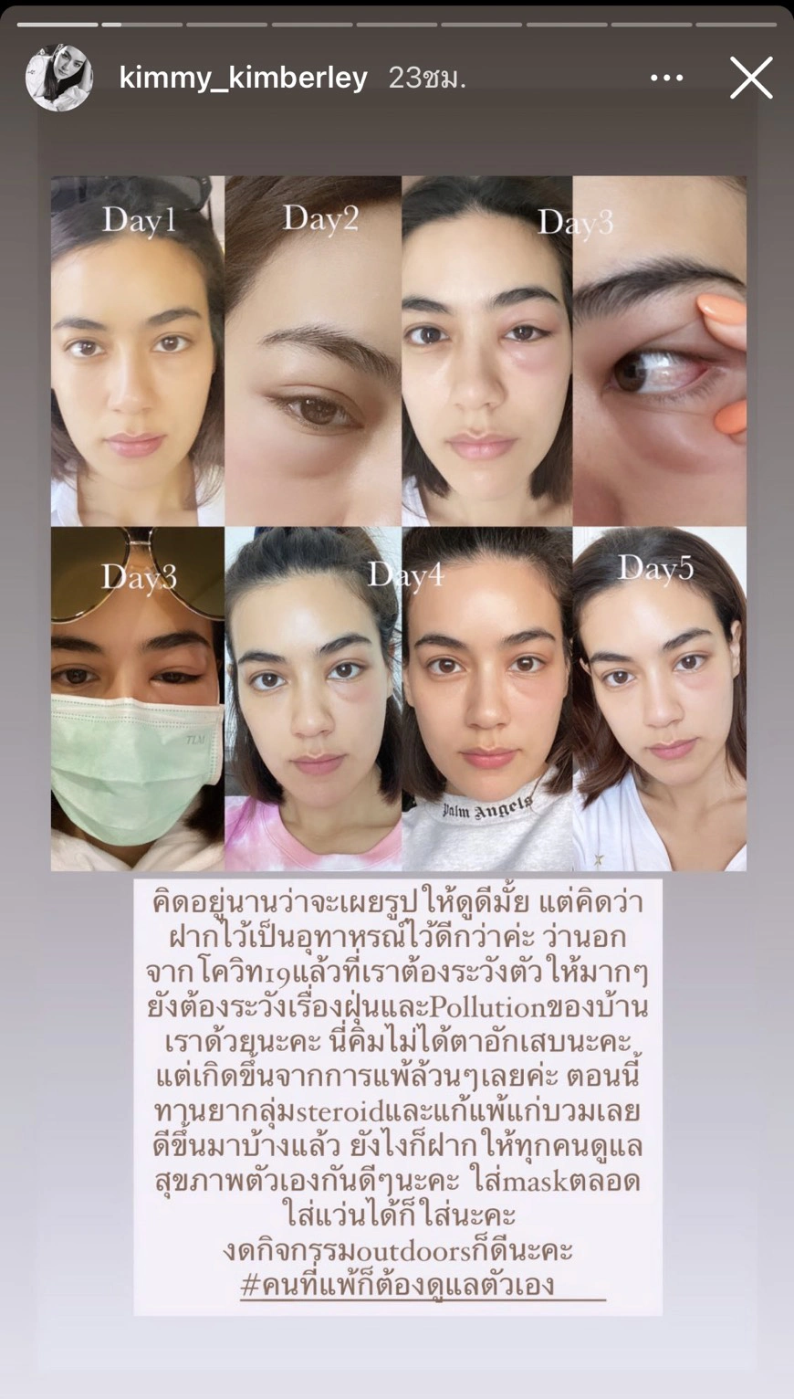 คิมเบอร์ลี่ ฝากอุทาหรณ์ หลังแพ้ฝุ่นจนตาบวมหนัก