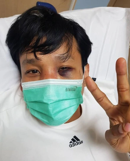 เอ็กซ์ ธิตินันท์ เผยจมูกหัก เบ้าตาแตก ข้อมือซ้น หลังแลกหมัด รัศมีแข
