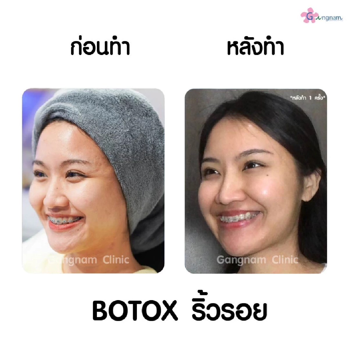 ลดอายุผิว คืนความอ่อนเยาว์ด้วยการฉีดโบท็อกซ์ริ้วรอย