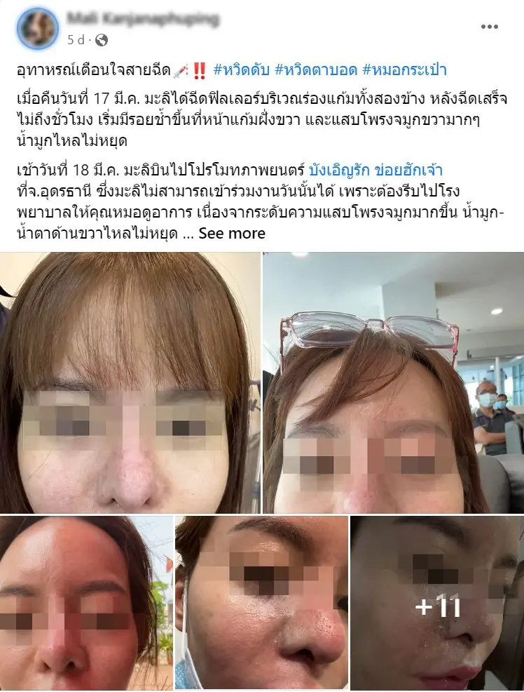 นายแพทย์วัชพล ธนมิตรามณี หมอคนดัง เตือน! ฉีดฟิลเลอร์กับหมอกระเป๋าอาจถึงตาย