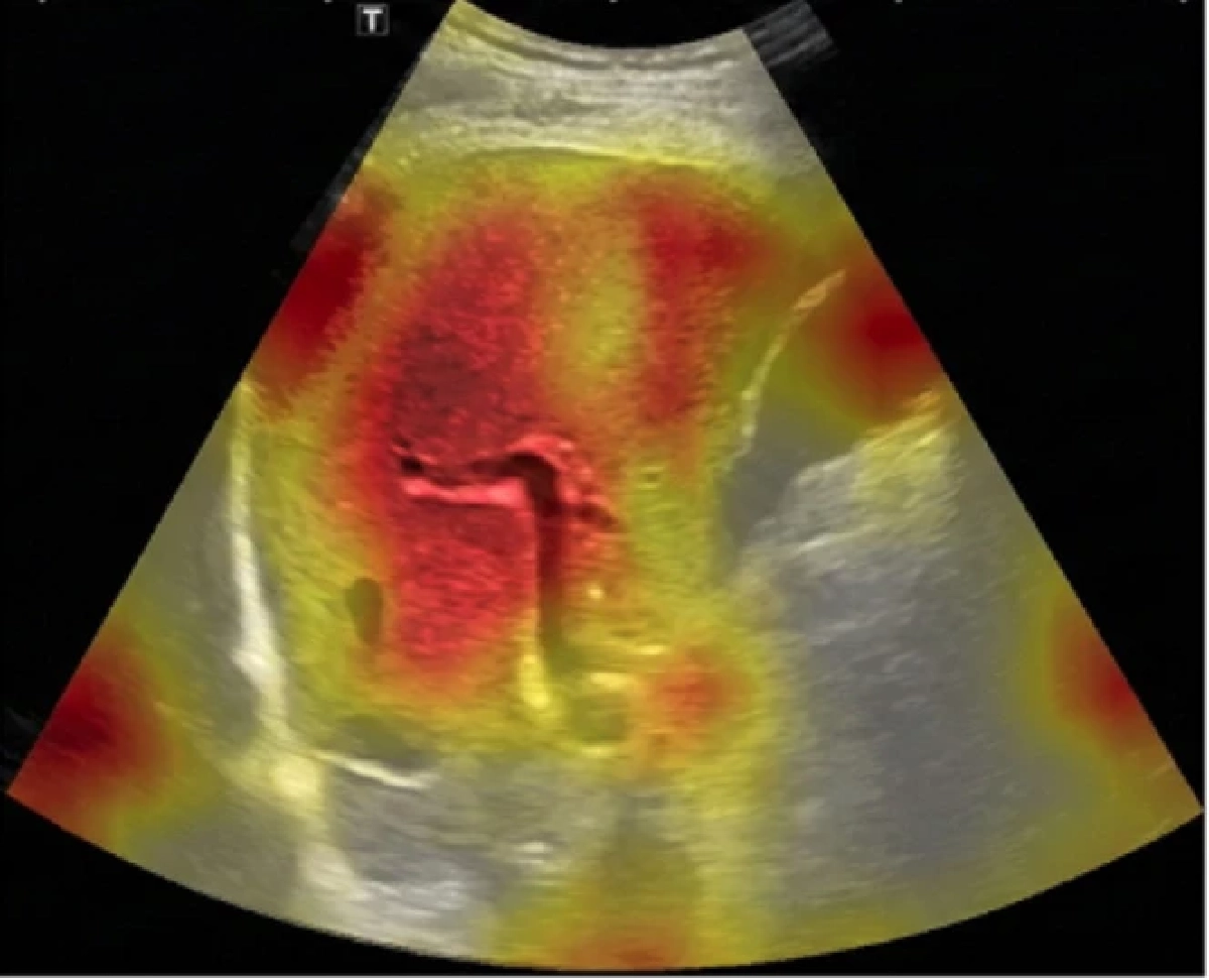 ‘AI ตรวจค่าตับ’ ฝีมือนักศึกษาไทยจาก มจธ. รู้ผลใน 7 วินาที แม่นยำถึง 92%