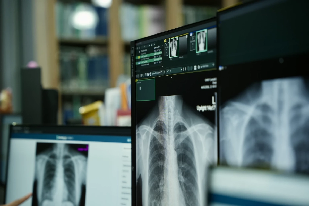 RAMAAI CXR Solution : AI ผู้ช่วยลดภาระแพทย์ อ่านฟิล์ม x-ray ทรวงอก เร็ว-แม่นยำ
