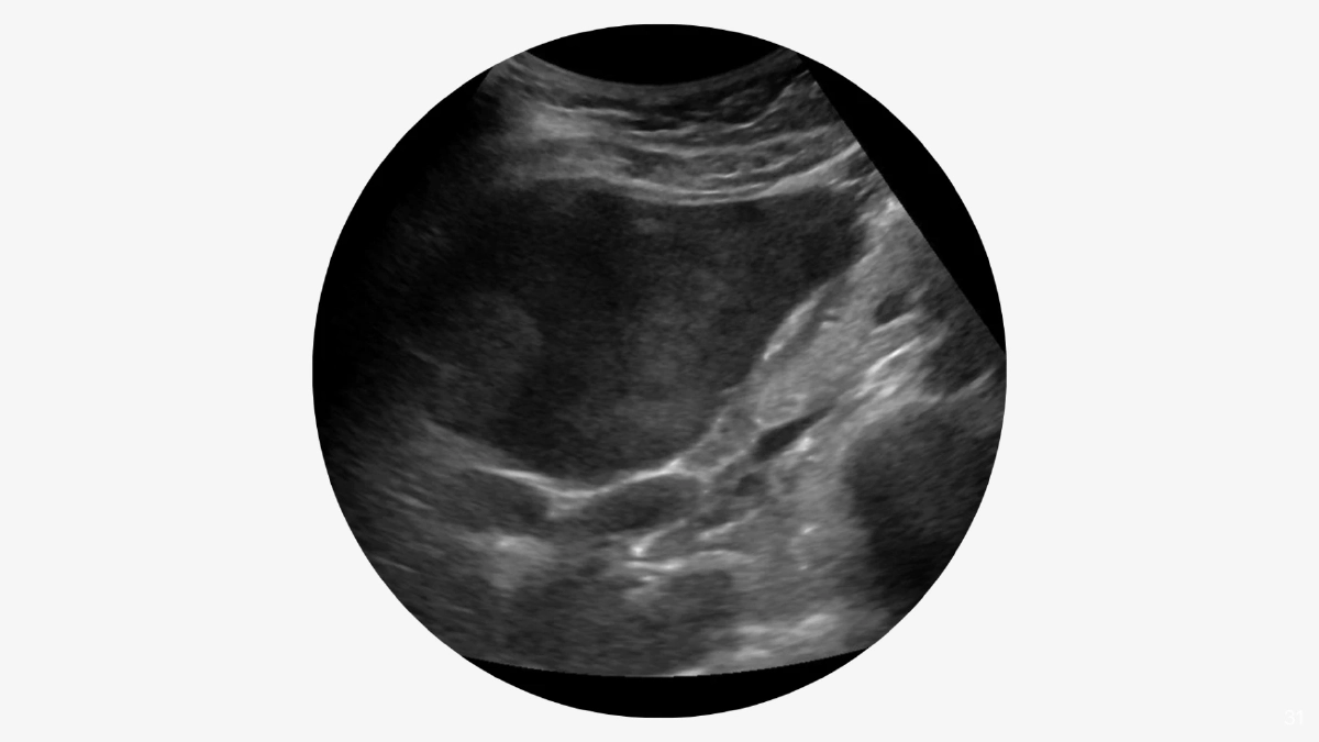 ‘AI ตรวจค่าตับ’ ฝีมือนักศึกษาไทยจาก มจธ. รู้ผลใน 7 วินาที แม่นยำถึง 92%