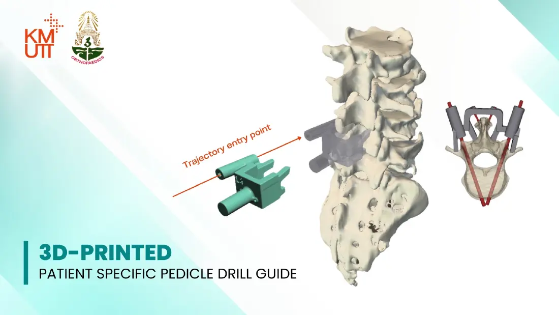 มจธ.ผนึก 3 รพ. ใช้ AI-3D Printing สร้างอุปกรณ์แพทย์เฉพาะบุคคล ลดความเสี่ยงการรักษา