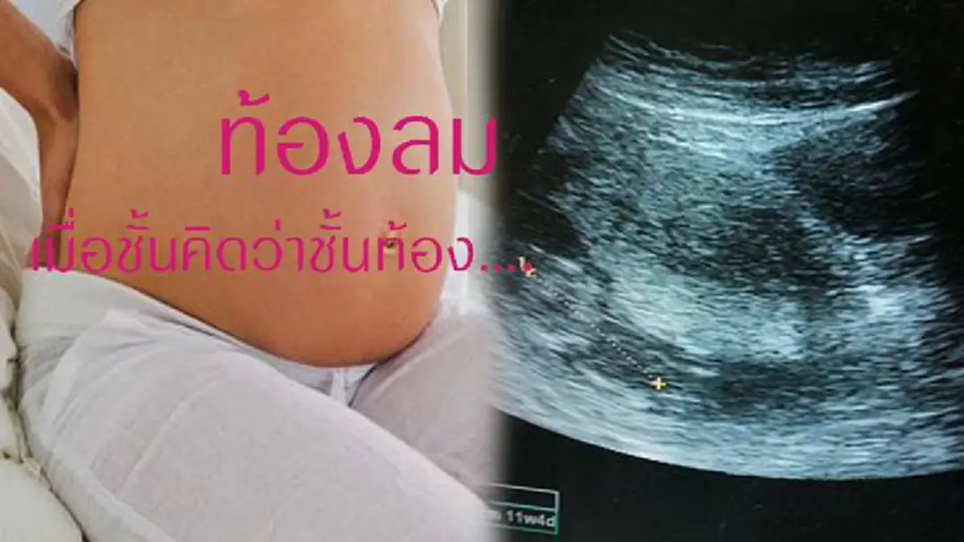 ท้องลม ท้องเทียม เมื่อชั้นคิดว่าตัวเองท้อง ท้องลม ท้องเทียม เมื่อชั้นคิดว่าตัวเองท้อง