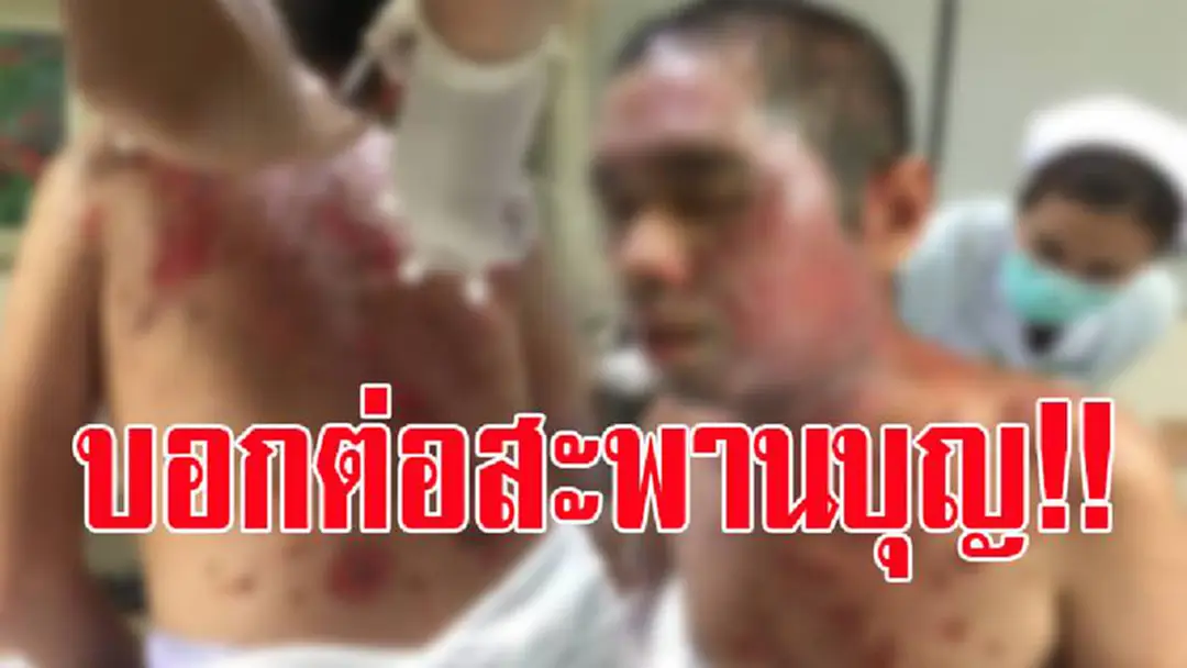 "หนุ่มนักปั่น" ป่วยเป็นโรคหายาก สุดทรมานผิวหนังลอก เคราะห์ซ้ำแถมติดเชื้อ เพื่อนครวญช่วยหาค่ายาราคาเกือบครึ่งล้าน!?