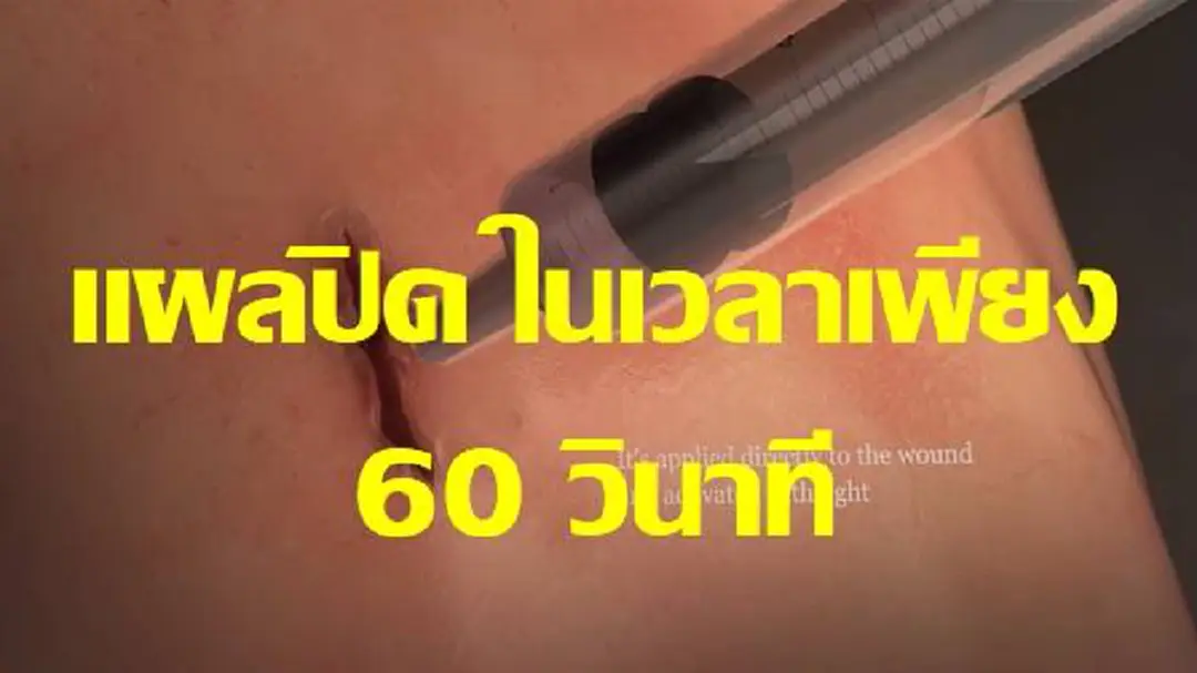 ค้นพบกาว ปิดแผล ไม่ต้องเย็บแผลอีกต่อไป แม้แต่ในหัวใจ และ ปอด แค่ 60 วินาที แผลปิดสนิท ค้นพบกาว ปิดแผล ไม่ต้องเย็บแผลอีกต่อไป แม้แต่ในหัวใจ และ ปอด แค่ 60 วินาที แผลปิดสนิท