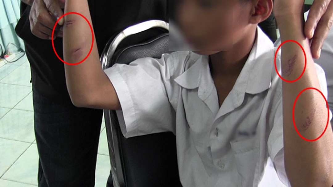 แม่เลี้ยงใจร้าย! ควงไม้ฟาดลูกลายทั้งตัว จนท.เร่งช่วยด่วน