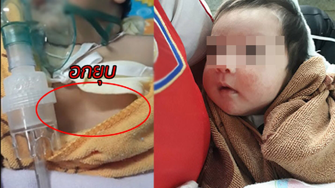 สงสารจับใจ! แม่โพสต์ ลูกเป็นหวัด "พ่นยา-ดูดสเลด" สุดท้ายหน้าอกยุบ สงสารจับใจ! แม่โพสต์ ลูกเป็นหวัด "พ่นยา-ดูดสเลด" สุดท้ายหน้าอกยุบ