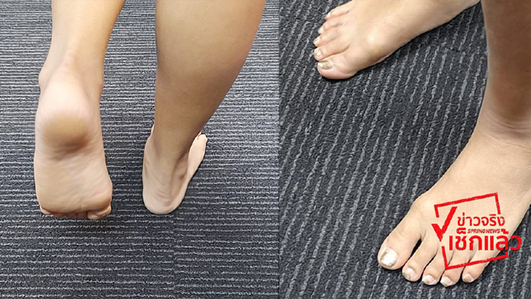 อย่าหลงเชื่อ! แผ่นแปะ "ดีท็อกซ์เท้า" แก้สารพัดโรค #ข่าวจริงเช็กแล้ว