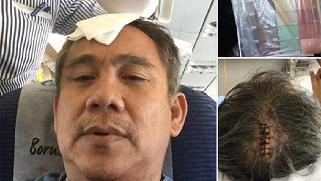 หามส่ง รพ. "ศุ บุญเลี้ยง" ของตกใส่หัว บนเครื่องบิน เย็บ 7 เข็ม หามส่ง รพ. "ศุ บุญเลี้ยง" ของตกใส่หัว บนเครื่องบิน เย็บ 7 เข็ม