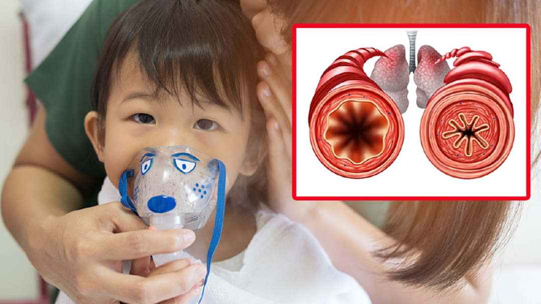 แพทย์รามาฯ เตือน! ฝุ่น PM 2.5 ตัวสำคัญของคนเป็น "หอบหืด" แพทย์รามาฯ เตือน! ฝุ่น PM 2.5 ตัวสำคัญของคนเป็น "หอบหืด"