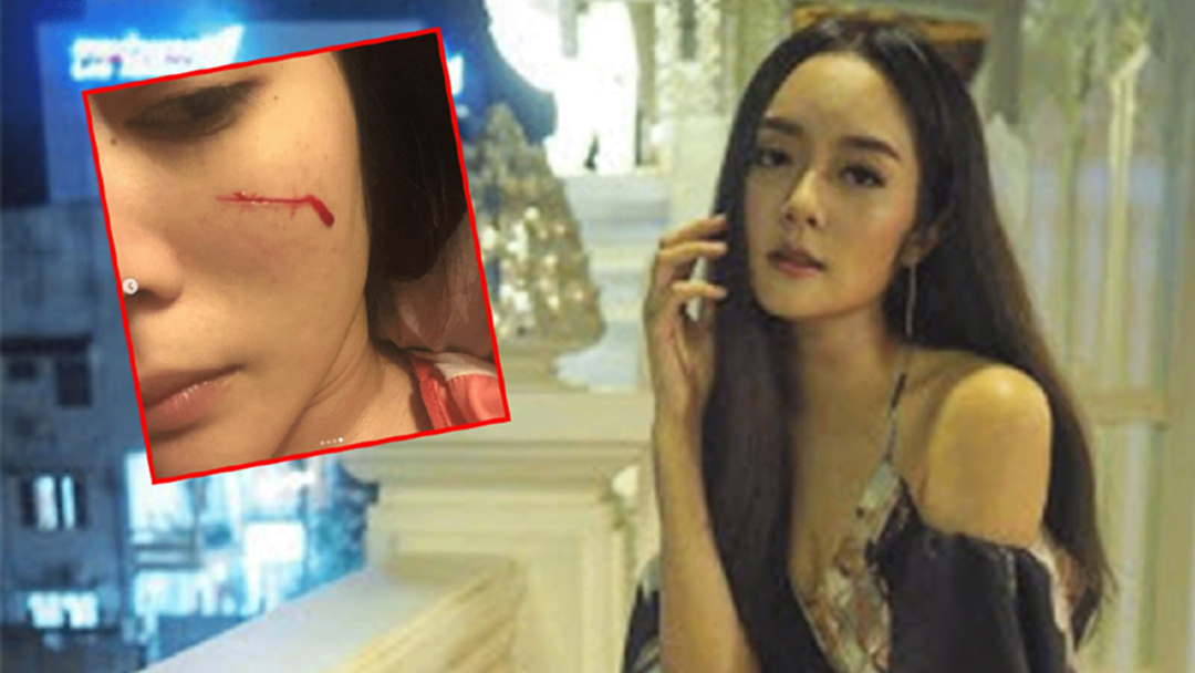 หวิดเสียโฉม "แก้มบุ๋ม" โชว์แผล โดนแมวข่วนจนเลือดไหล! หวิดเสียโฉม "แก้มบุ๋ม" โชว์แผล โดนแมวข่วนจนเลือดไหล!