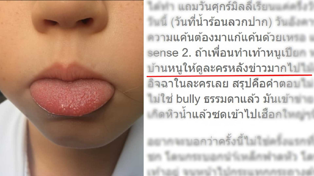 แม่สับ! เพื่อนที่รร. แก้แค้น "กดน้ำร้อนลวกปาก" ทำลูก 7 ขวบลิ้นพอง