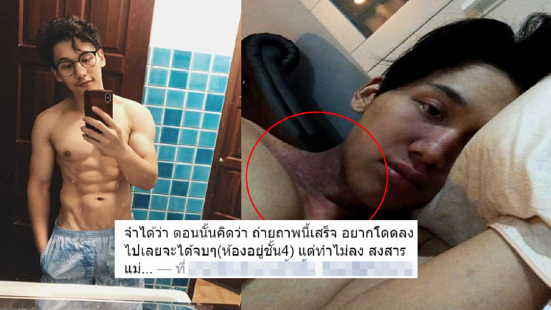 อัศจรรย์! หนุ่มหล่อป่วย "มะเร็งหลังโพรงจมูก" คอไหม้ ผอมซูบ ก่อนสู้จนกลับมาได้ อัศจรรย์! หนุ่มหล่อป่วย "มะเร็งหลังโพรงจมูก" คอไหม้ ผอมซูบ ก่อนสู้จนกลับมาได้
