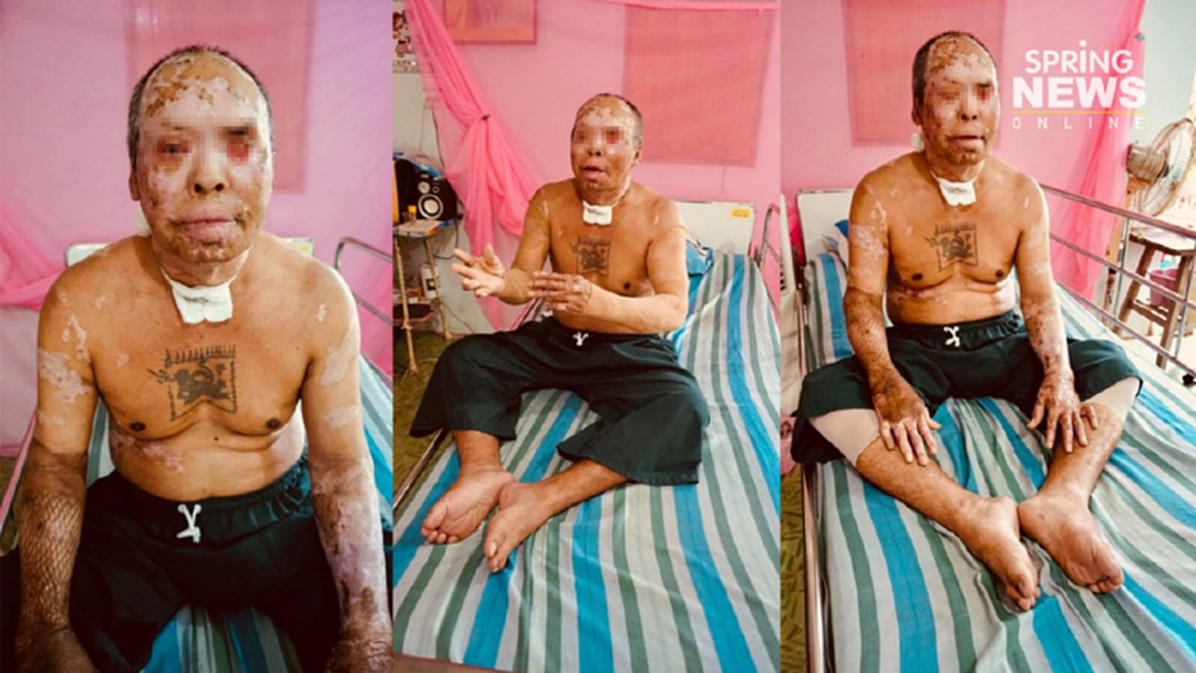 ฮีโร่ที่ถูกลืม! วอนช่วยอาสาเสี่ยงช่วยเหตุแก๊สรั่ว จนโดนระเบิดใส่