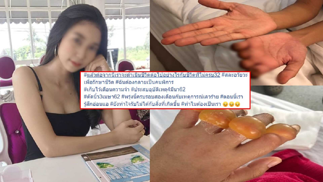 นักศึกษาสาวปี 4 เล่าอุบัติเหตุฝึกงานทำพิการ "ตัดออก 4 นิ้ว" นักศึกษาสาวปี 4 เล่าอุบัติเหตุฝึกงานทำพิการ "ตัดออก 4 นิ้ว"
