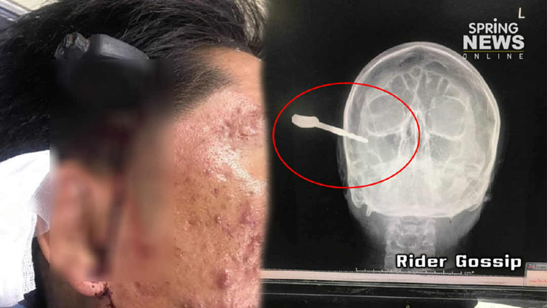 หนุ่มแว้นหัวร้อน!  ควงหมัดยัดกุญแจเสียบกะโหลกคู่กรณี