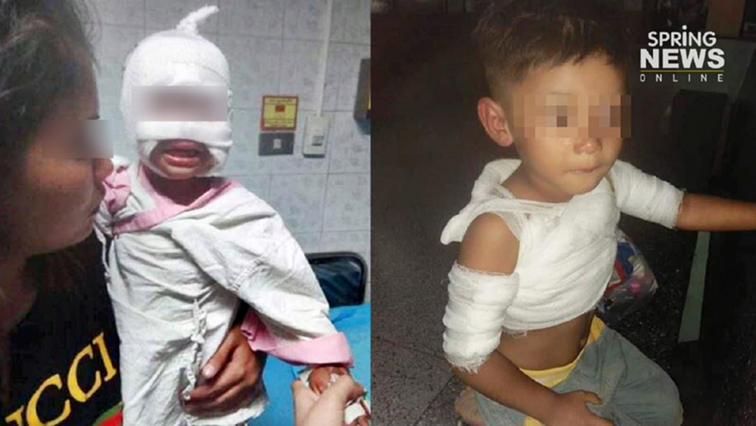 อุทาหรณ์! 2 หนูน้อยโยนกระป๋องสเปรย์เข้ากองไฟ ระเบิดใส่ตาหวิดบอด