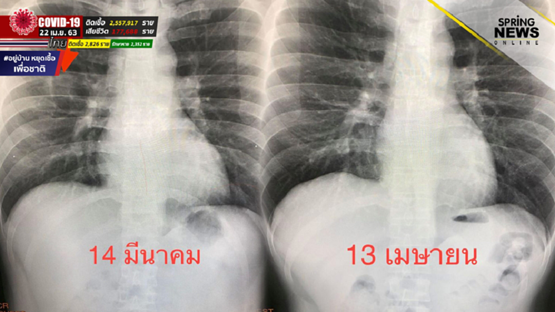 "หมอมนูญ" เผยสภาพปอดผู้ป่วยที่ติดโควิด 19 จาก Super spreader 1 คน "หมอมนูญ" เผยสภาพปอดผู้ป่วยที่ติดโควิด 19 จาก Super spreader 1 คน