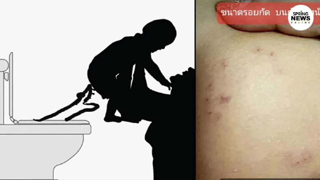 แม่โพสต์เตือนภัย พาลูกน้อยเข้าห้องน้ำกลางดึก งูพุ่งจากโถส้วมฉกก้นลูก แม่โพสต์เตือนภัย พาลูกน้อยเข้าห้องน้ำกลางดึก งูพุ่งจากโถส้วมฉกก้นลูก