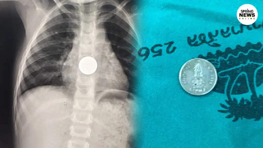 อุทาหรณ์ผู้ปกครองปล่อย หนูน้อย 2 ขวบอยู่ลำพัง กลืนเหรียญลงคอน้ำลายฟูมปาก