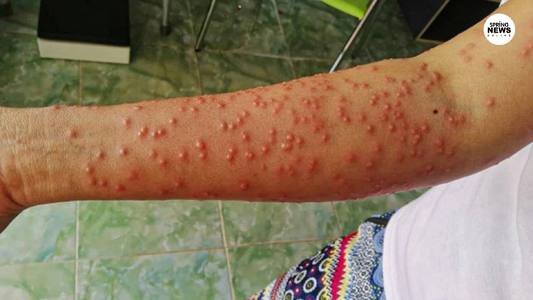 หมอยืนยัน โรคพยาธิหอยคัน แค่ผิวอักเสบไม่ถึงตาย