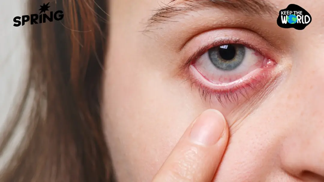 ฝุ่น PM2.5 ไม่ได้แค่ทำลายแค่ปอด ยังส่งผลต่อ "ดวงตา" ทำให้ตาแดง เยื่อบุตาอักเสบ